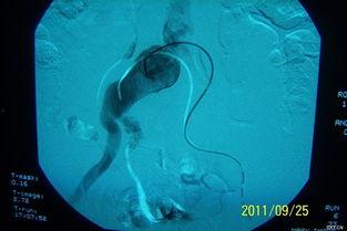 国产主动脉支架视频,视频揭秘国产医疗科技新篇章