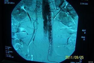 国产主动脉支架视频,视频揭秘国产医疗科技新篇章